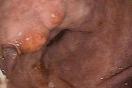 Scope image of a gastic ulcer